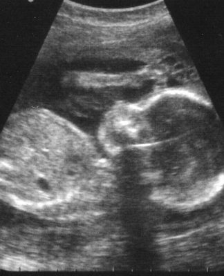 Prueba sanguínea podría identificar a las mujeres embarazadas que corren peligro del nacimiento prematuro